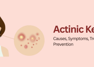 Actinic Keratosis: Causes, Symptoms, Treatment, and Prevention