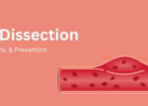Aortic Dissection: Causes, Symptoms, & Prevention