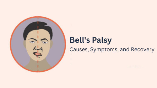 Bell’s Palsy: Causes, Symptoms, and Recovery