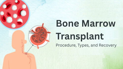 Bone Marrow Transplant: Procedure, Types, and Recovery