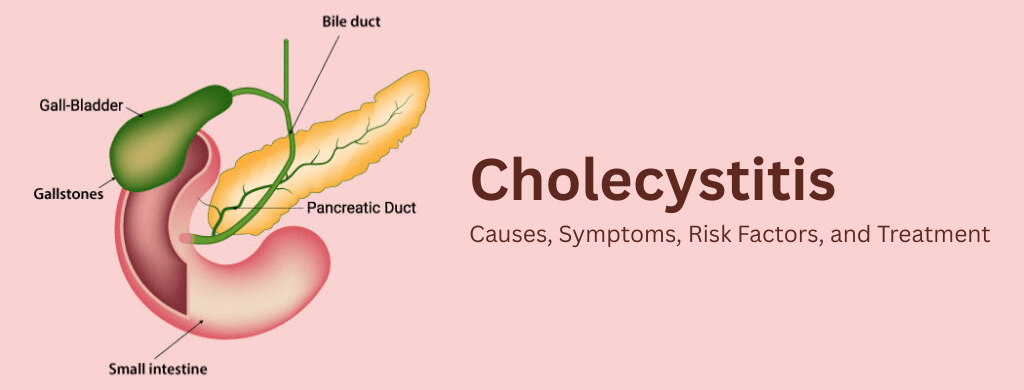 Cholecystitis: Causes, Symptoms, Risk Factors, and Treatment Cholecystitis: Causes, Symptoms, Risk Factors, and Treatment