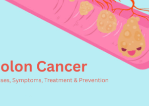 Colon Cancer: Causes, Symptoms, Treatment & Prevention