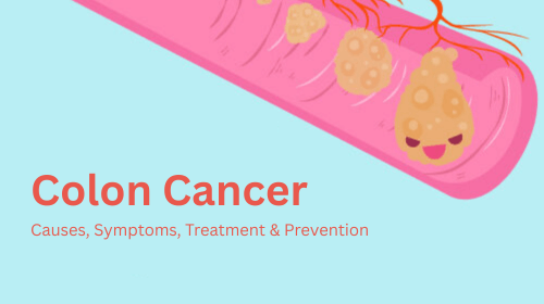 Colon Cancer: Causes, Symptoms, Treatment & Prevention