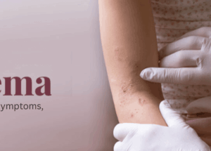 Eczema (Dermatitis): Causes, Types, Symptoms, & Treatment