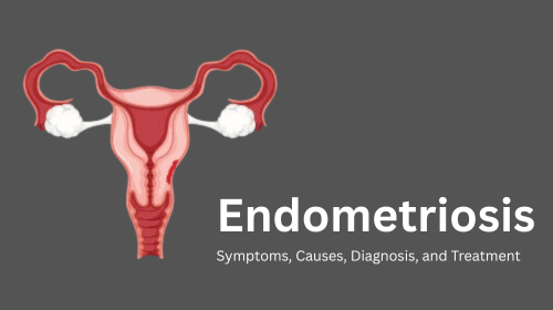 Endometriosis: Symptoms, Causes, Diagnosis, and Treatment