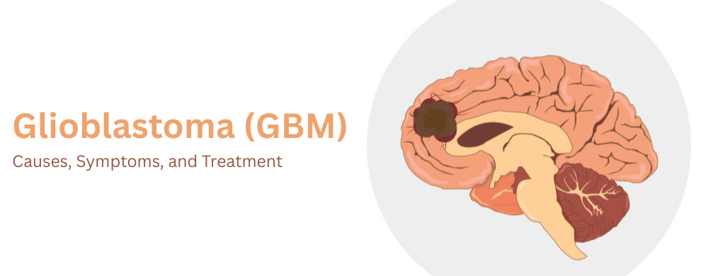 Glioblastoma (GBM): Causes, Symptoms, and Treatment