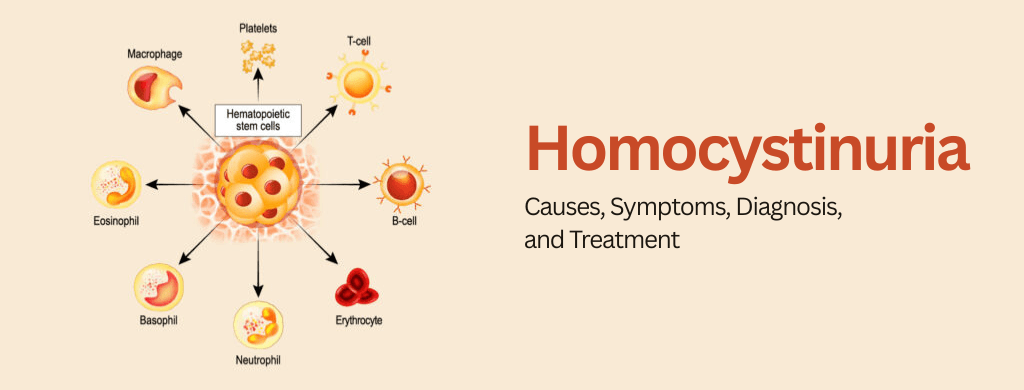 Homocystinuria: Causes, Symptoms, Diagnosis, and Treatment