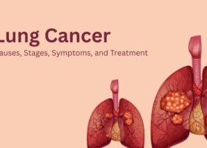 Lung Cancer: Causes, Stages, Symptoms, and Treatment