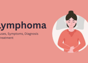 Lymphoma: Causes, Symptoms, Diagnosis & Treatment