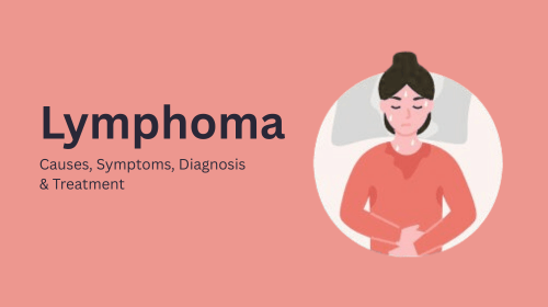 Lymphoma: Causes, Symptoms, Diagnosis & Treatment