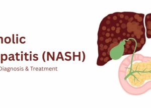 Nonalcoholic Steatohepatitis (NASH): Causes, Symptoms, Diagnosis & Treatment