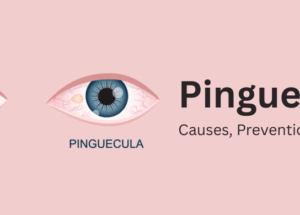 Pinguecula: Causes, Prevention, and Treatment