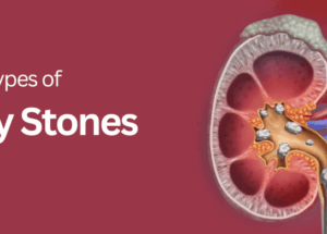 أنواع مختلفة من حصوات الكلى موضحة