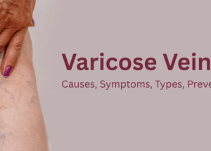Varicose Veins: Causes, Symptoms, Types, Prevention & Treatment