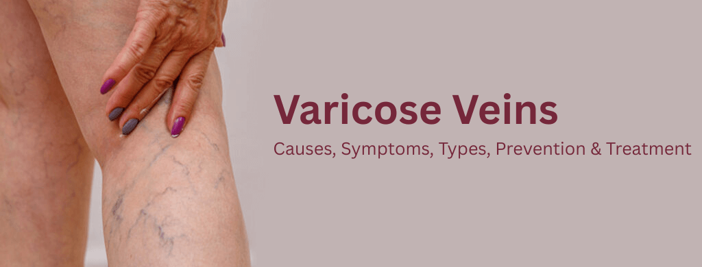 Varicose Veins: Causes, Symptoms, Types, Prevention & Treatment