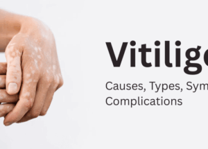 Vitiligo: Causes, Types, Symptoms, and Complications
