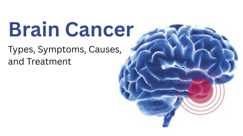 Brain Cancer: Types, Symptoms, Causes, and Treatment