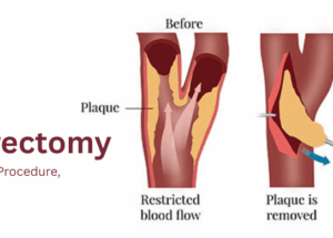 Carotid Endarterectomy: A Complete Guide to Procedure, Risks & Recovery
