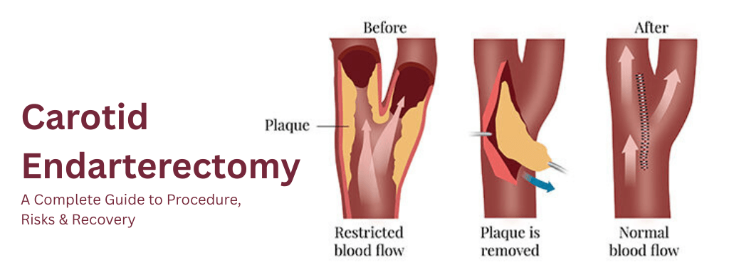 Carotid Endarterectomy: A Complete Guide to Procedure, Risks & Recovery