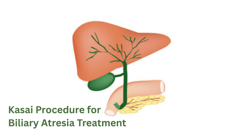 Kasai Procedure for Biliary Atresia Treatment