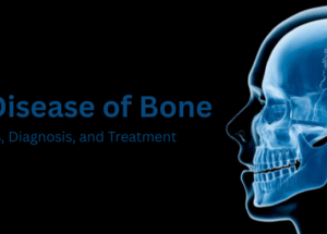Paget’s Disease of Bone: Causes, Symptoms, Diagnosis, and Treatment
