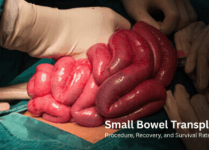 Small Bowel Transplant: Procedure, Recovery, and Survival Rates