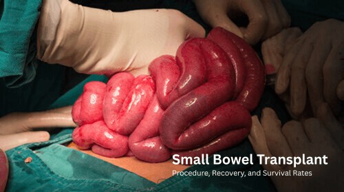 Small Bowel Transplant: Procedure, Recovery, and Survival Rates