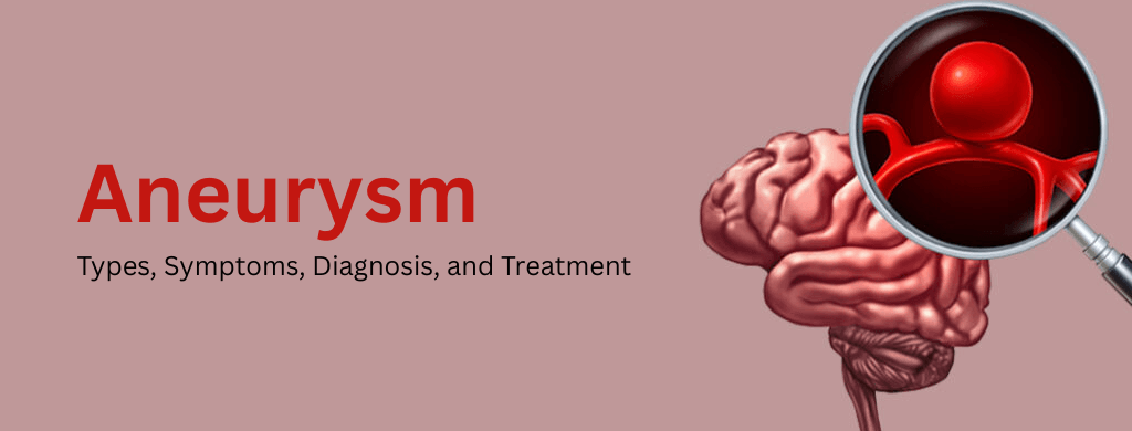 Aneurysm: Types, Symptoms, Diagnosis, and Treatment