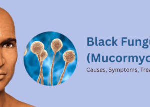 Black Fungus (Mucormycosis): Causes, Symptoms, Treatment, and Prevention