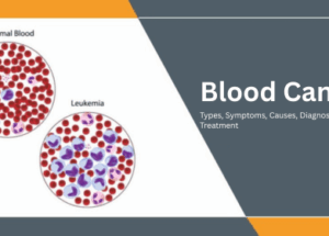 Blood Cancer: Types, Symptoms, Causes, Diagnosis & Treatment