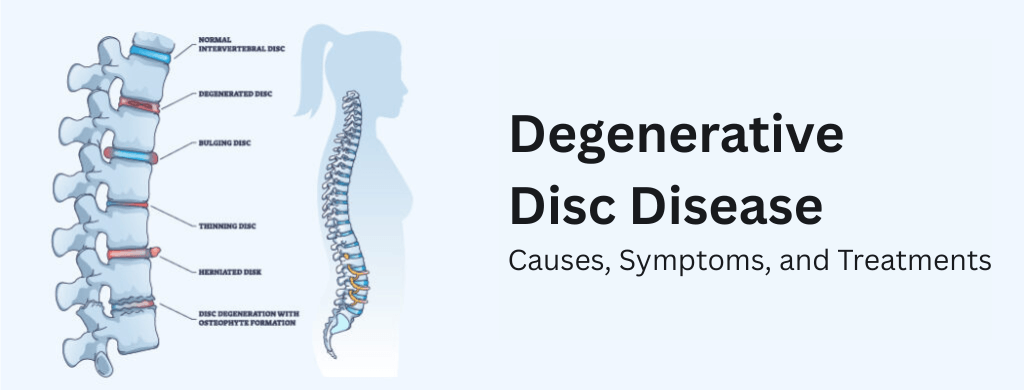 Degenerative Disc Disease: Causes, Symptoms, and Treatments