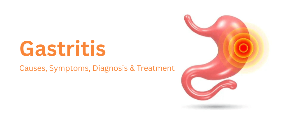 Gastritis: Causes, Symptoms, Diagnosis & Treatment