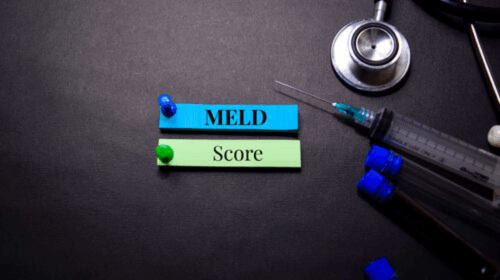MELD Score for Liver Transplant: A Guide for Patients