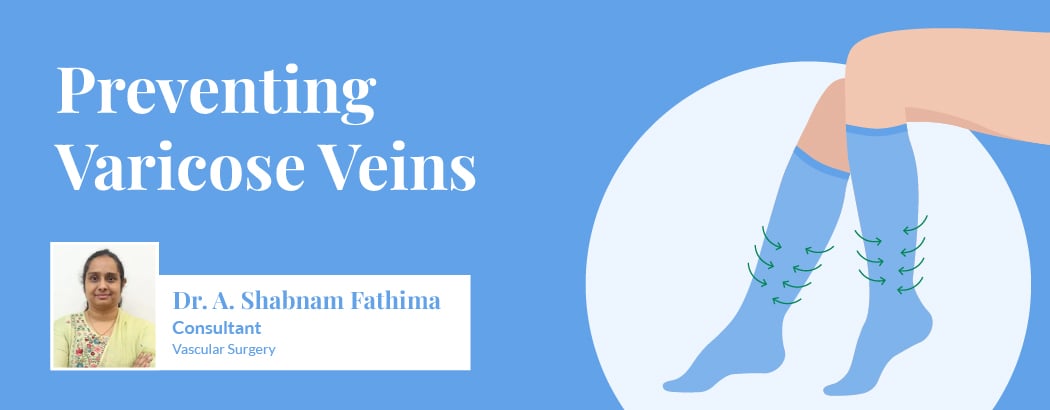 How to Prevent Varicose Veins: Lifestyle Tips and Home Remedies