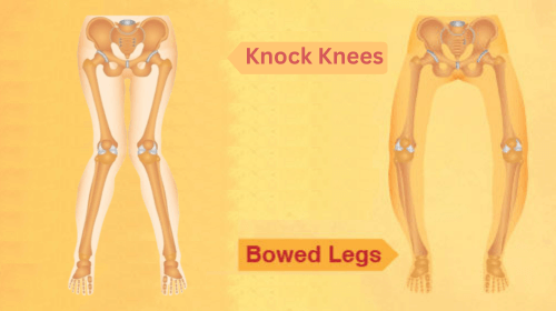 Bow Legs and Knock Knees in Children: Causes, Symptoms, and Treatment