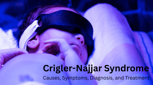 Crigler-Najjar Syndrome: Causes, Symptoms, Diagnosis, and Treatment