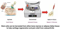 Knee Osteoarthritis (4)