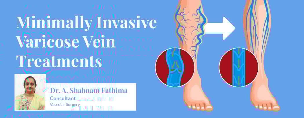 Minimally Invasive Varicose Vein Treatments