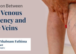 Chronic Venous Insufficiency vs Varicose Veins: Connection, Symptoms & Risks