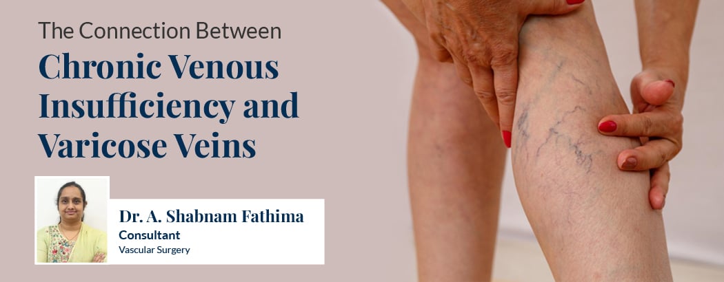 Chronic Venous Insufficiency vs Varicose Veins: Connection, Symptoms & Risks