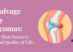 Limb Salvage Surgery for Sarcomas: Techniques That Preserve Function and Quality of Life