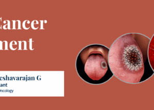 Oral Cancer: Stages, Causes, Diagnosis, and Treatment